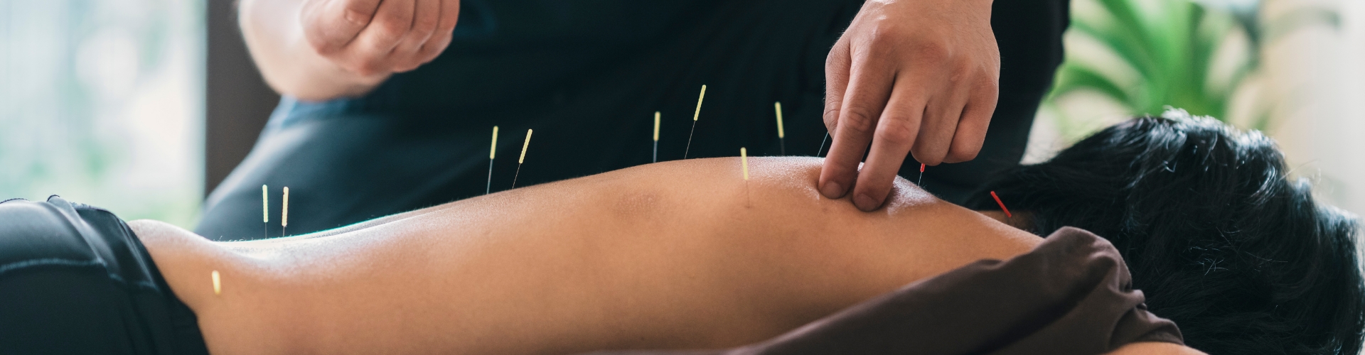 Acupuncture