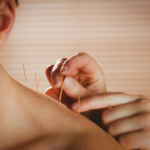 acupuncture-Premier-Physiotherapy-and-Sports-Medicine-Vaughan-ON